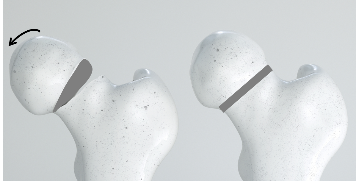 Slipped capital femoral epiphysis